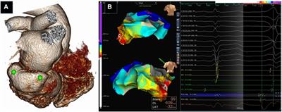 Catheter ablation of ventricular tachycardia: strategies to improve outcomes